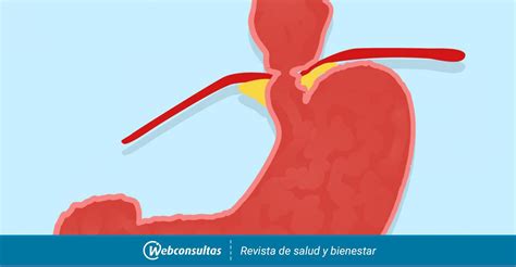 Qué Es La Hernia De Hiato