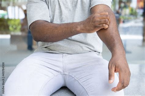 Stockfoto Med Beskrivningen Man Scratching Suffering From Itching Arm