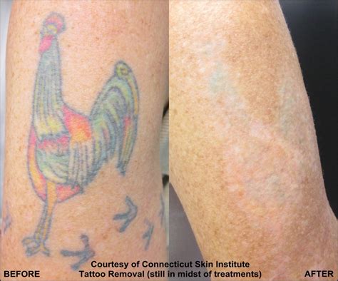 Laser tattoo removal works by targeting pigment colors in the skin's dermis, the layer of skin between the some people see results immediately. 2.laser.tattoo.removal.arm.get.rid.of.tattoo.color.ink ...