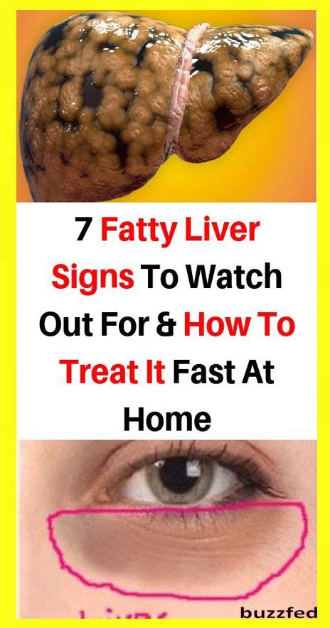 Fatty Liver Symptoms Sings To Watch Out For And How To Treat It Fast
