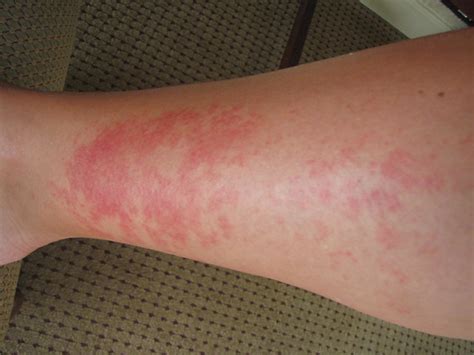 Weird Rash I Got On My Legs Flickr Photo Sharing