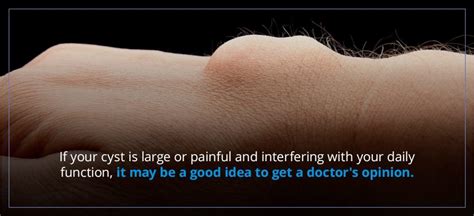 What To Do When A Ganglion Cyst Ruptures Orthobethesda