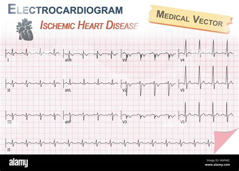 Electrocardiogram Ecg Ekg Of Ischemic Heart Disease Myocardial