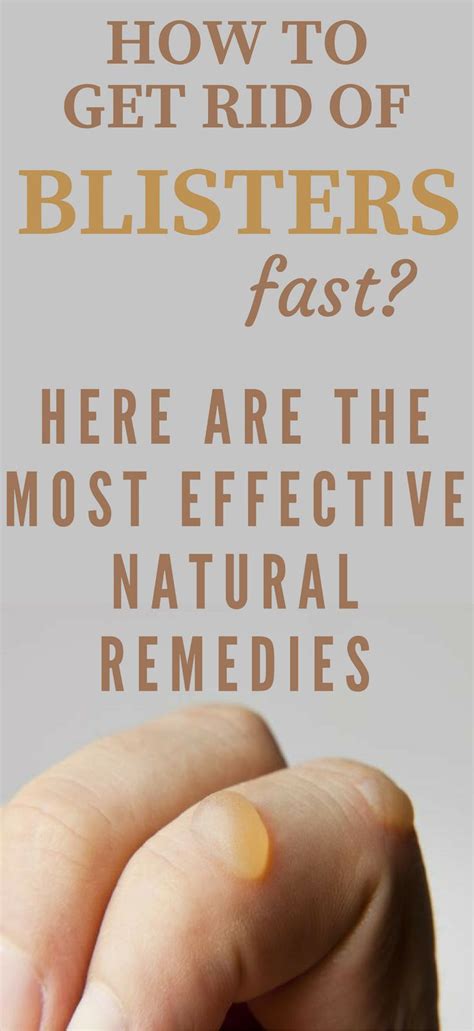 How To Get Rid Of Blisters Fast Here Are The Most Effective Natural