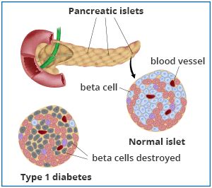 Type 1 diabetes is an autoimmune disease. Pancreatic Islet Transplantation | NIDDK