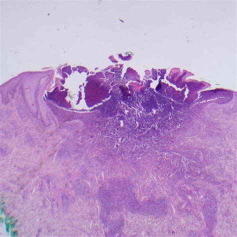 Pdf Invasive Dermatophyte Infection With Trichophyton Interdigitale