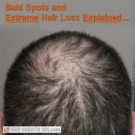 Why Bald Spots And Bald Patches Develop On The Back Of The Head