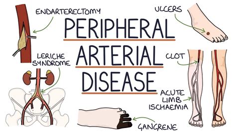 Understanding Peripheral Arterial Disease Diabetes