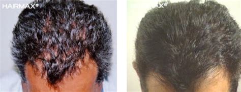Before After Hairmax Secure Store