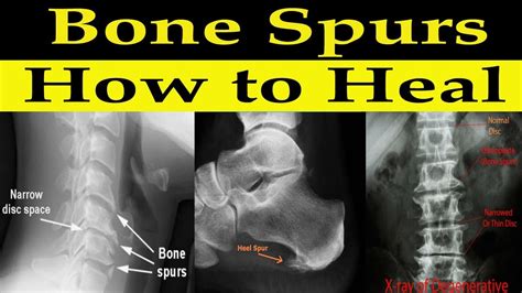 How To Heal Bone Spurs Naturally Dr Alan Mandell Dc Youtube