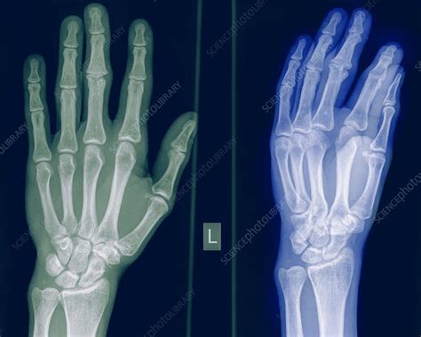 X Ray Of A Healthy Hand Stock Image C Science Photo Library