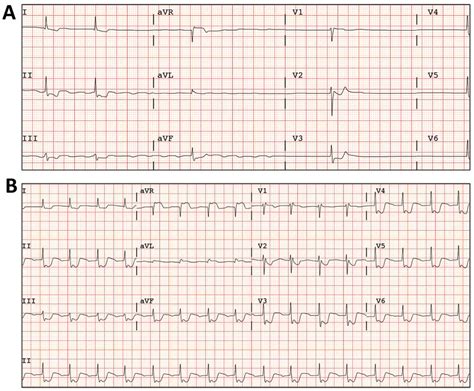 A Atypical Atrial Flutter Alterning With Atrial Silence B Ecg After