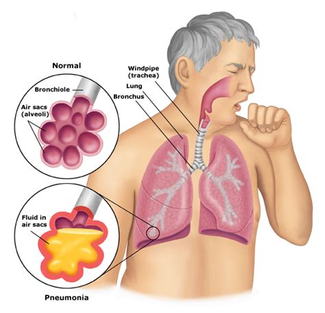 Medical Pictures Info Pneumonia