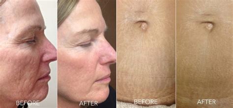 Microneedling Stomach Before And After