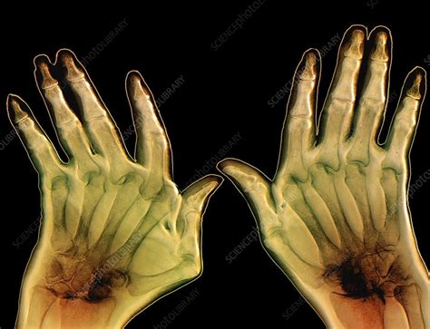 Arthritic Hands X Ray Stock Image C0180534 Science Photo Library