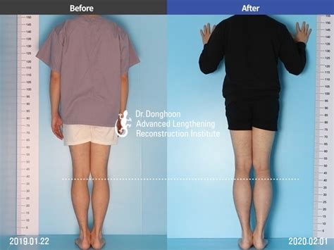 65cm Of Tibial Lengthening By Lon Method Limb Lengthening And Complex Reconstruction Service