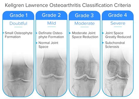 Osteoarthritis Stages Knee