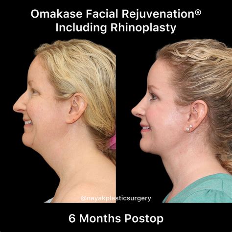 Facelift And Neck Before And After Patient 32 Nayak Plastic Surgery