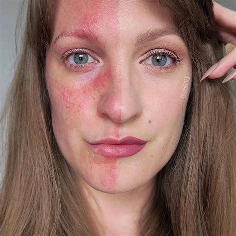 Best Practices For Using Makeup On Rosacea Skin
