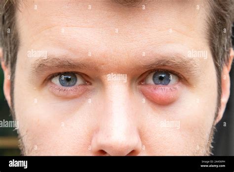 A Man With A Swollen Eyelid Due To An Infection Stock Photo Alamy