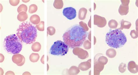 Chronic Myeloid Leukaemia Bcr‐abl1‐positive In Accelerated Phase With