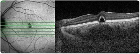 Cienciasmedicasnews What Is Optical Coherence Tomography