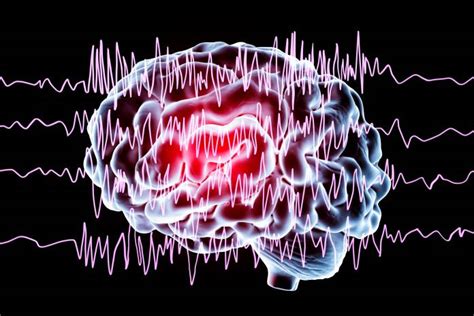 Epilepsie Epileptischer Anfall Ursachen Symptome Therapie