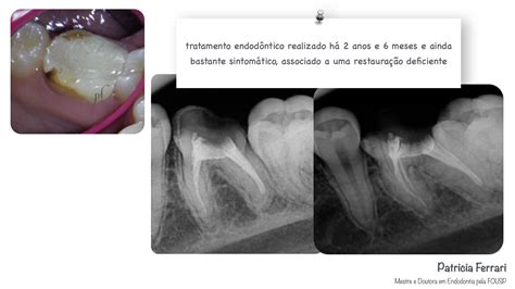 Retratamento Em Dente Sintom Tico Patricia Ferrari Endodontia