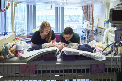 Separating Conjoined Twins Only The Beginning Of Challenges