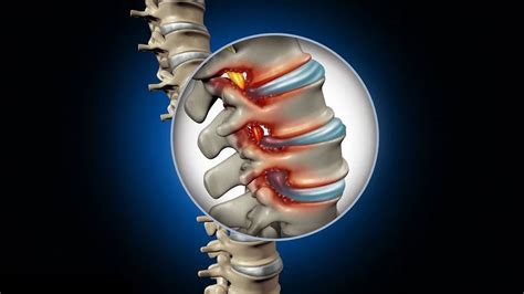 Can My Chiropractor Help My Spinal Stenosis — Garden State Spinal Care