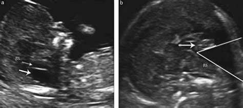 Appearance Of Fetal Posterior Fossa At 1114 Weeks In Fetuses With