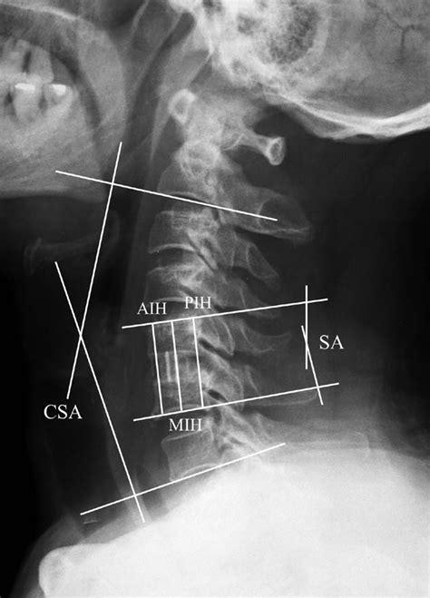 Cervical Sagittal Angle Csa Segmental Angle Sa And Anterior