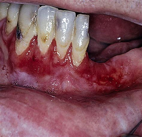 Desquamative Gingivitis Intelligent Dental