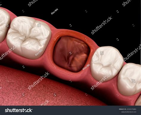 Blood Clot Seals Off Tooth After Stock Illustration 2152171801