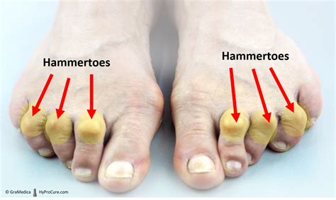 Hammertoe Hyprocure The Proven Solution To Misaligned Feet