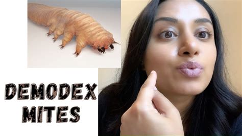 Demodex Mites On The Face Youtube