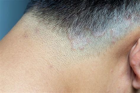 Closed Up Of Ringworm Tinea On Head Of Asian Man Stock Photo Image Of
