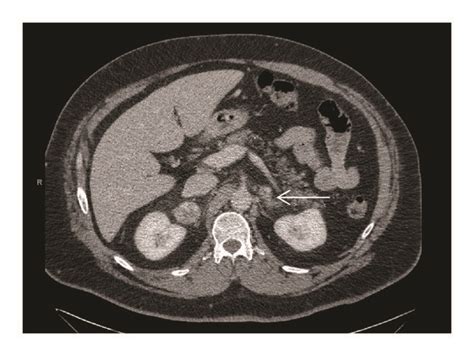 Ct Scan Of The Abdomen Showing The Right Adrenal Tumor A Arrow And