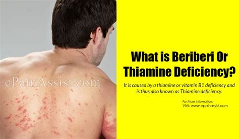 What Is Beriberi Or Thiamine Deficiencycausessymptomstreatmenthome