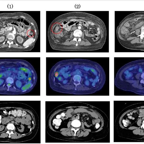 Abdominal Computed Tomography Ct Images And Positron Emission