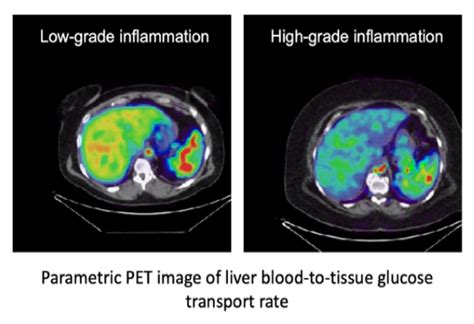 New Pet Imaging Based Tool Detects Liver Inflammation From Fatty Liver