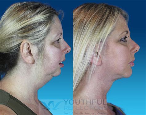 Chin Implant Before And After Photos Patient 64 Nashville Tn