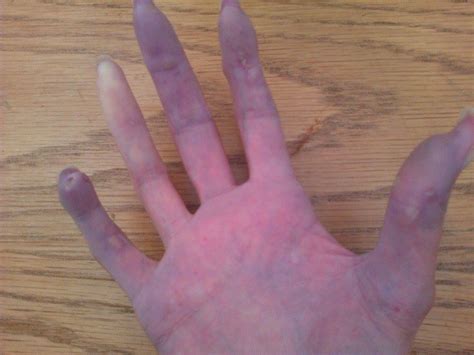 Raynauds Scleroderma Global Patients Day 7 Raynauds Phenomenon