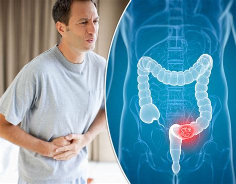 Bowel Cancer Warning Does Your Skin Feel Like This The Warning Sign