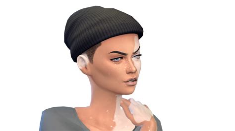 The Sims 4 Create A Sim Vitiligo Youtube Vrogue