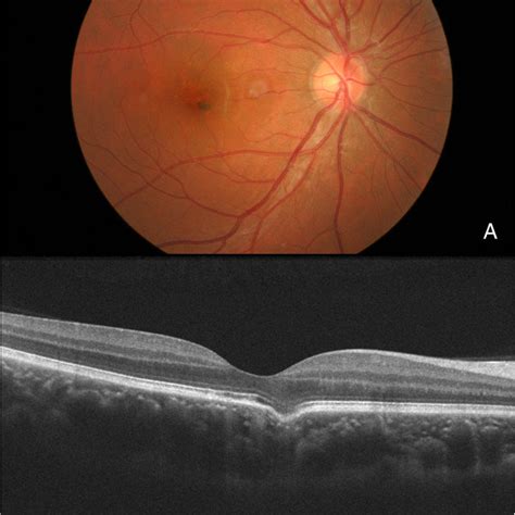 Focal Choroidal Excavation With Concomitant Central Serous