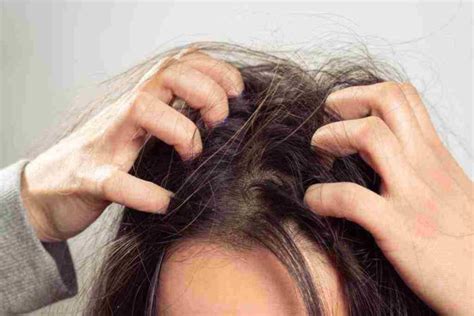 Nah, jerawat yang berada di kulit kepala akan menyebabkan rasa gatal dan lebih sulit ditangani karena biasanya tertutupi oleh rambut kita. Jerawat di Kepala: Penyebab, Cara Mengatasi, & Pencegahan