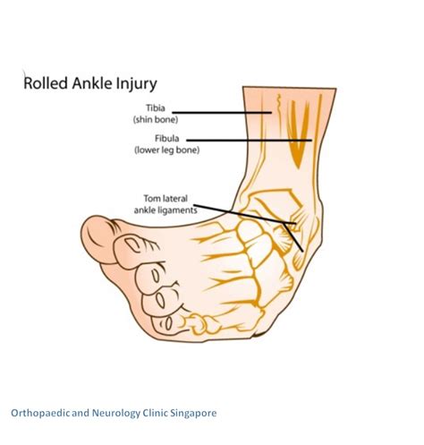 Ankle Pain Clinic 脚踝诊所 Comprehensive Ankle Treatment