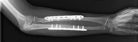 FOREARM FRACTURES FIXED | buyxraysonline