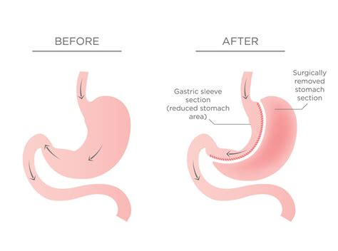 Tijuana Bc Gastric Sleeve Side Effects Sleeve Gastrectomy Surgery